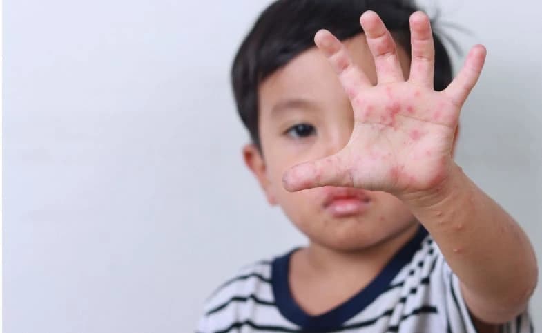 Kenali Campak: Gejala, Penyebab, Pengobatan, dan Kapan Harus Waspada?